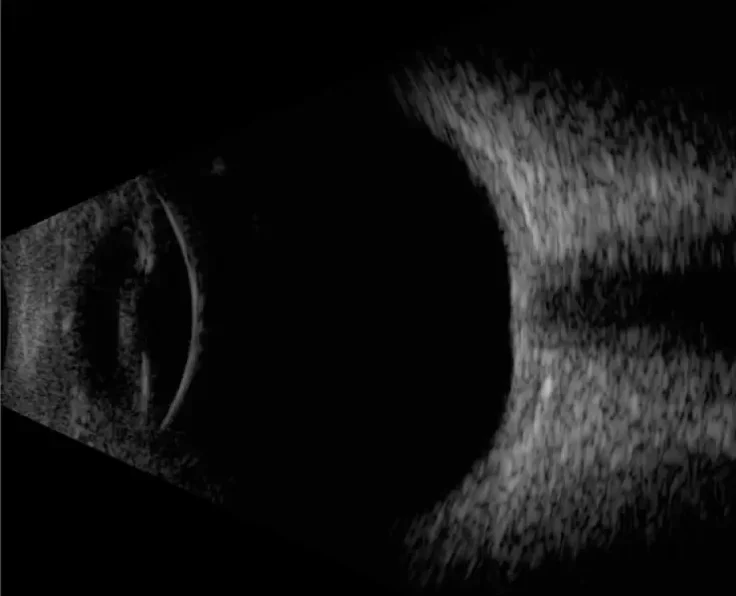Échographie oculaire